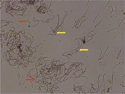 Oxidative Stress in the Rostral Ventrolateral Medulla Contributes To Cardiovascular Regulation in Preeclampsia